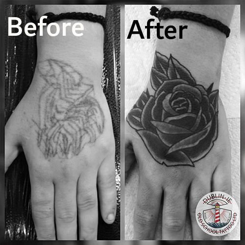 image of tattoo laser removal 